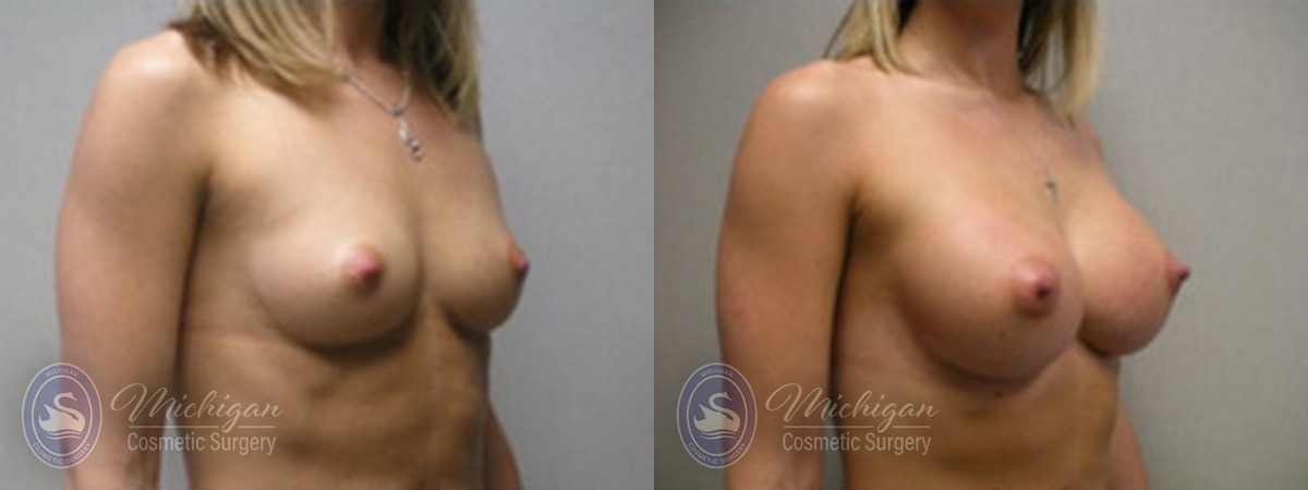 Michigan Cosmetic Surgery Southfield Breast Augmentation P