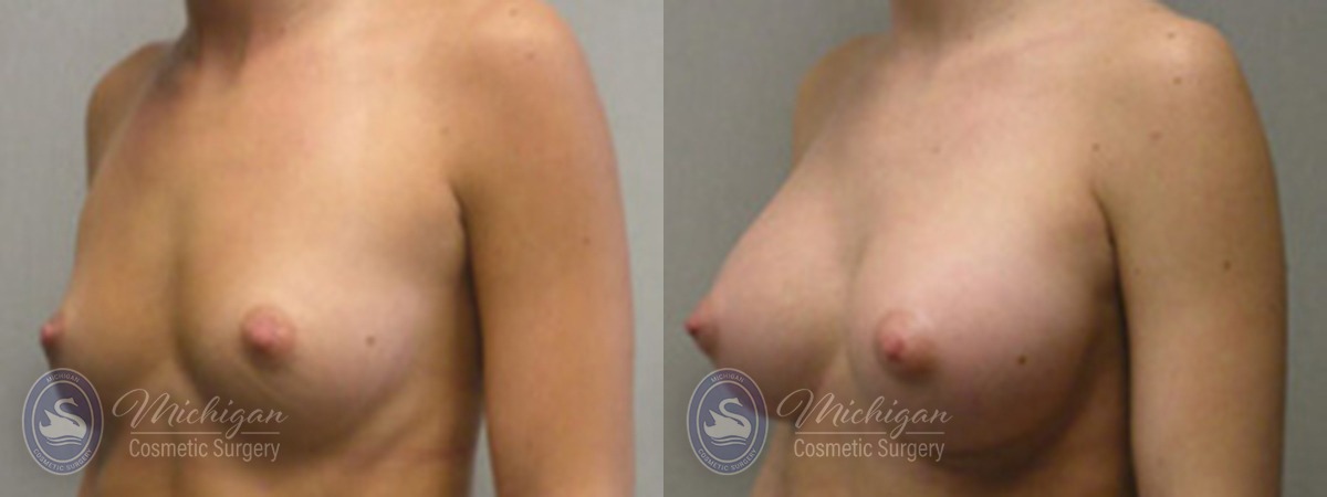 Michigan Cosmetic Surgery Southfield Breast Augmentation P