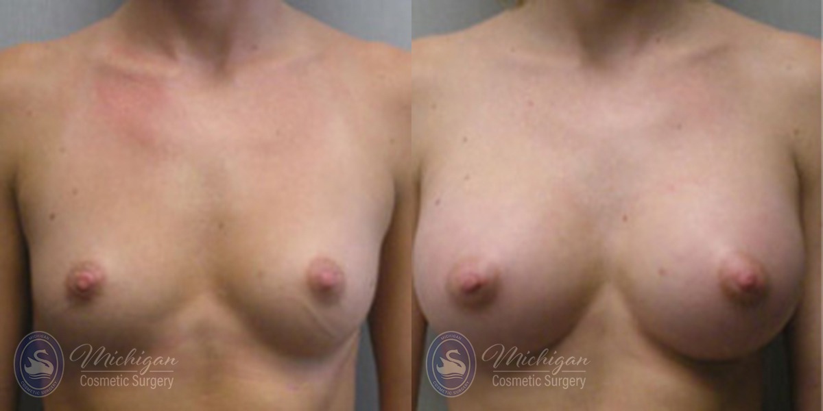 Michigan Cosmetic Surgery Southfield Breast Augmentation P