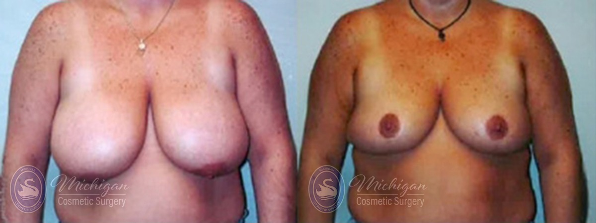 Michigan Cosmetic Surgery Southfield Breast Reduction P