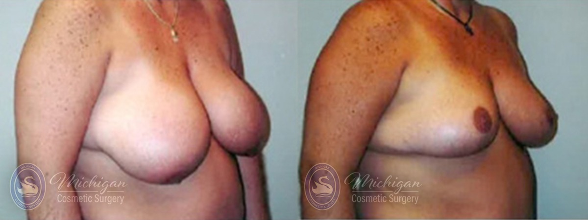Michigan Cosmetic Surgery Southfield Breast Reduction P