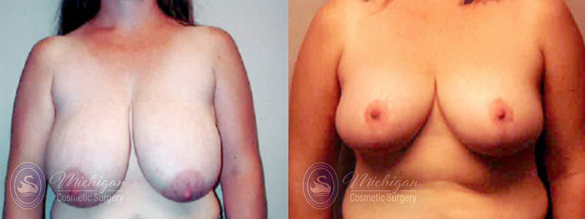 Michigan Cosmetic Surgery Southfield Breast Reduction P