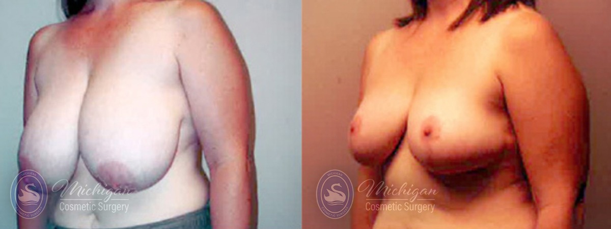 Michigan Cosmetic Surgery Southfield Breast Reduction P