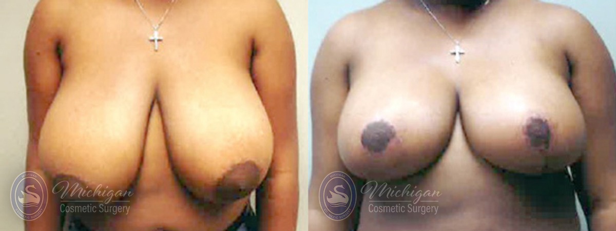 Michigan Cosmetic Surgery Southfield Breast Reduction P