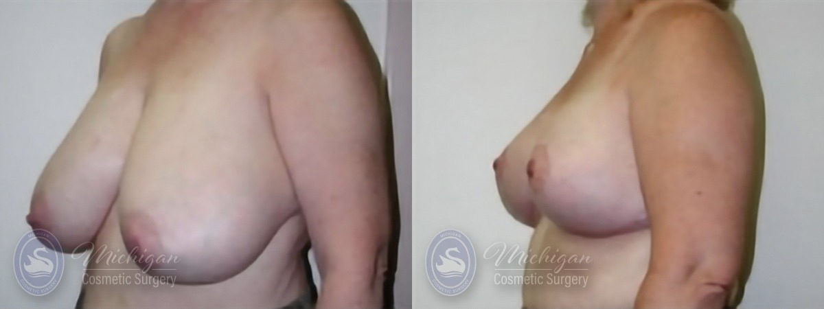 Michigan Cosmetic Surgery Southfield Breast Reduction P B