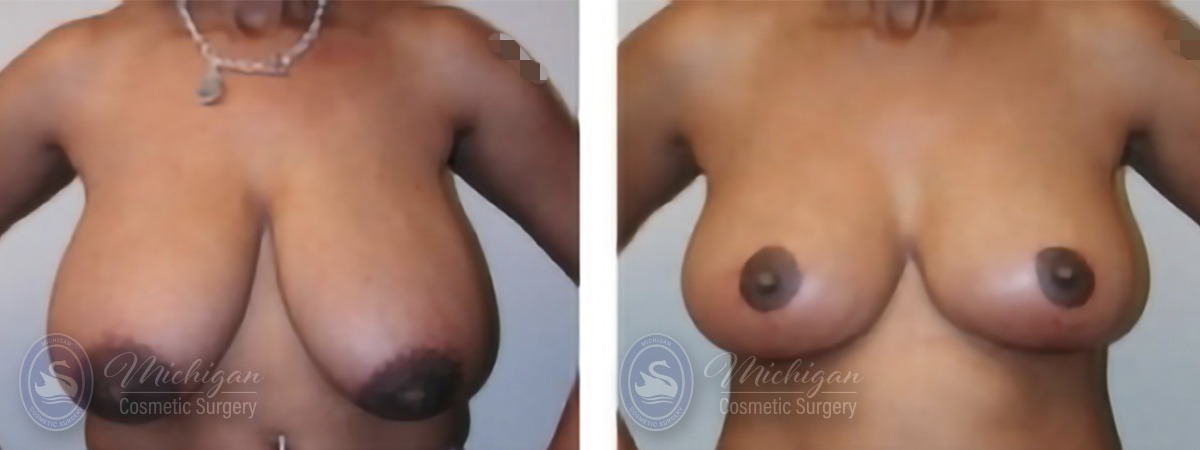 Michigan Cosmetic Surgery Southfield Breast Reduction P A