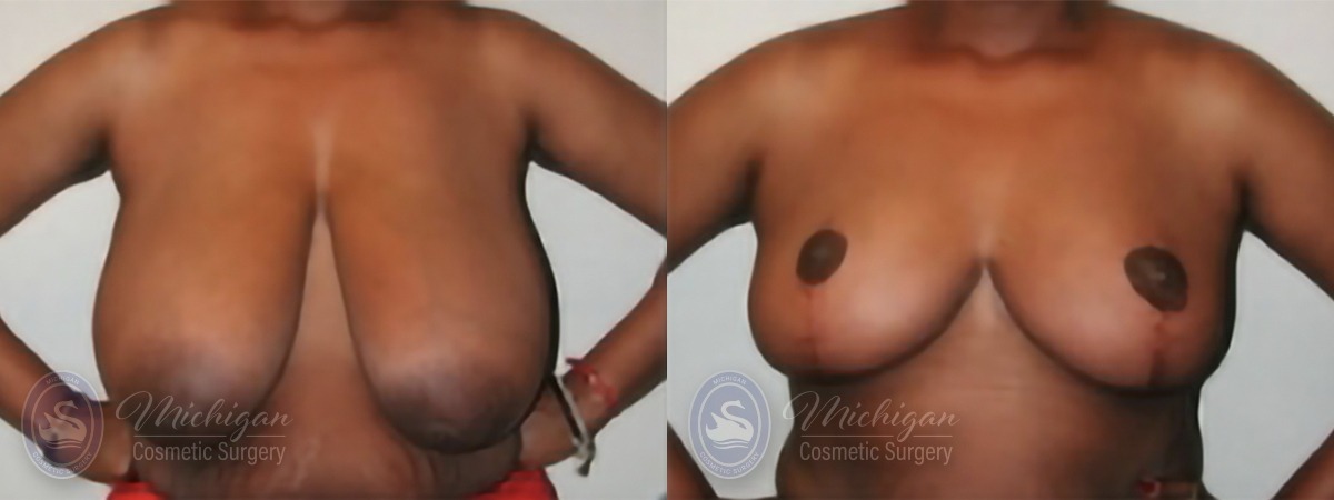 Michigan Cosmetic Surgery Southfield Breast Reduction P A
