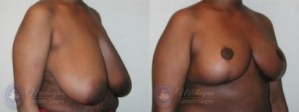 Michigan Cosmetic Surgery Southfield Breast Reduction P B