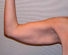 arm lift before photo by michigan cosmetic surgery in southfield mi