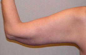 arm lift after photo by michigan cosmetic surgery in southfield mi