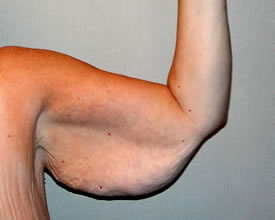 arm lift before photo by michigan cosmetic surgery in southfield mi