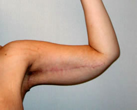 arm lift after photo by michigan cosmetic surgery in southfield mi