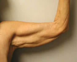 arm lift before photo by michigan cosmetic surgery in southfield mi