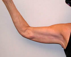 arm lift after photo by michigan cosmetic surgery in southfield mi