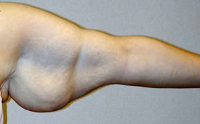 arm lift before photo by michigan cosmetic surgery in southfield mi
