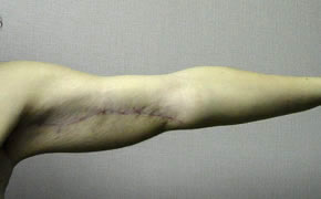 arm lift after photo by michigan cosmetic surgery in southfield mi
