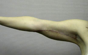 arm lift after photo by michigan cosmetic surgery in southfield mi