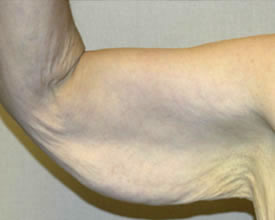 arm lift before photo by michigan cosmetic surgery in southfield mi