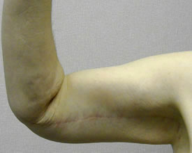 arm lift after photo by michigan cosmetic surgery in southfield mi