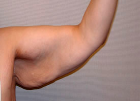 arm lift before photo by michigan cosmetic surgery in southfield mi