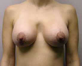 breast augmentation and lift after photo by michigan cosmetic surgery in southfield mi