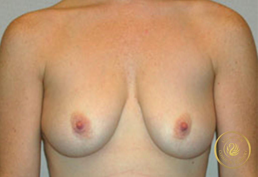 breast augmentation and lift before photo by michigan cosmetic surgery in southfield mi