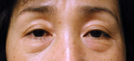 blepharoplasty before photo by michigan cosmetic surgery in southfield mi