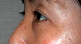 blepharoplasty after photo by michigan cosmetic surgery in southfield mi
