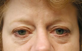blepharoplasty before photo by michigan cosmetic surgery in southfield mi