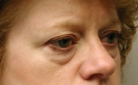 blepharoplasty before photo by michigan cosmetic surgery in southfield mi