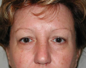 blepharoplasty before photo by michigan cosmetic surgery in southfield mi