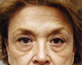 blepharoplasty before photo by michigan cosmetic surgery in southfield mi