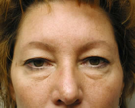 blepharoplasty before photo by michigan cosmetic surgery in southfield mi