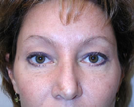 blepharoplasty after photo by michigan cosmetic surgery in southfield mi
