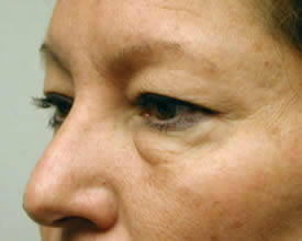 blepharoplasty before photo by michigan cosmetic surgery in southfield mi