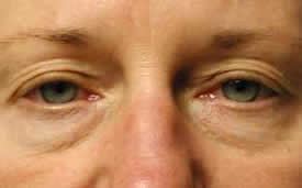 blepharoplasty before photo by michigan cosmetic surgery in southfield mi