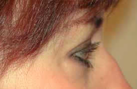 blepharoplasty after photo by michigan cosmetic surgery in southfield mi