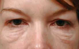 blepharoplasty before photo by michigan cosmetic surgery in southfield mi