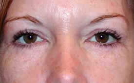 blepharoplasty after photo by michigan cosmetic surgery in southfield mi