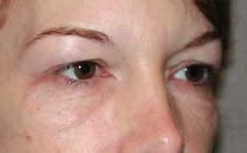 blepharoplasty before photo by michigan cosmetic surgery in southfield mi