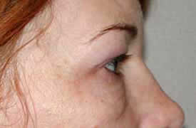 blepharoplasty before photo by michigan cosmetic surgery in southfield mi
