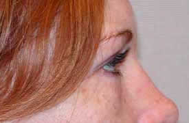 blepharoplasty after photo by michigan cosmetic surgery in southfield mi