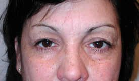 blepharoplasty before photo by michigan cosmetic surgery in southfield mi