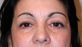 blepharoplasty after photo by michigan cosmetic surgery in southfield mi