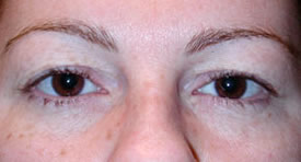 blepharoplasty before photo by michigan cosmetic surgery in southfield mi