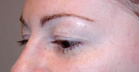 blepharoplasty before photo by michigan cosmetic surgery in southfield mi