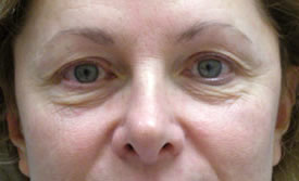 blepharoplasty before photo by michigan cosmetic surgery in southfield mi