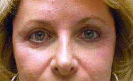 blepharoplasty after photo by michigan cosmetic surgery in southfield mi