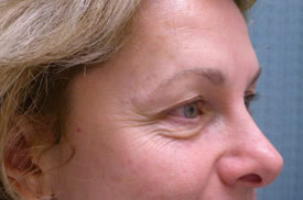 blepharoplasty before photo by michigan cosmetic surgery in southfield mi