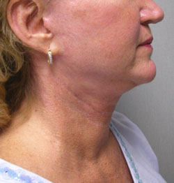 facelift after photo by michigan cosmetic surgery in southfield mi